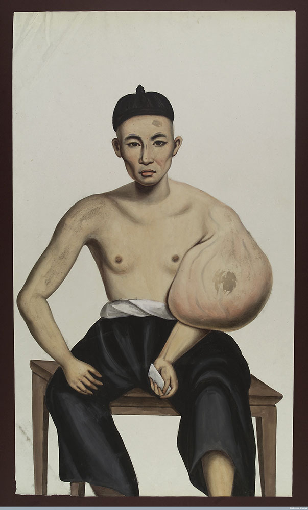 man with tumour Lam Qua